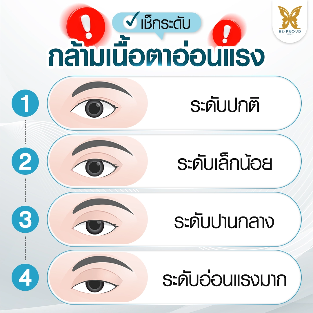 ตาปรือ ง่วงตลอดเวลา? เช็กระดับกล้ามเนื้อตาอ่อนแรง สัญญาณเตือนที่ต้องรีบแก้