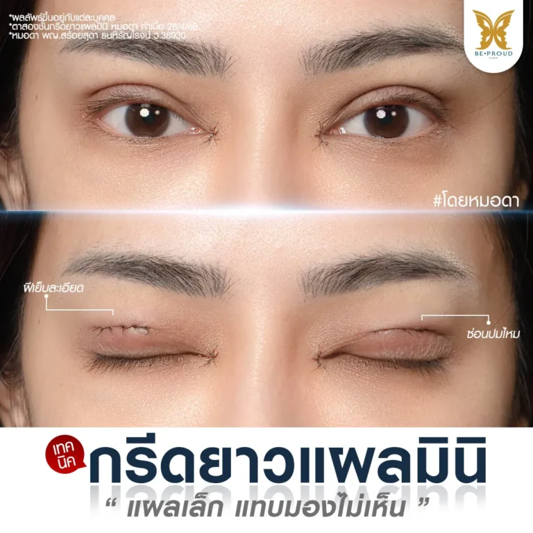 รีวิวตาสองชั้น เทคนิคกรีดยาวแผลมินิ ซ่อนปมไหม ฝีเย็บละเอียด โดยหมอดา Beproud Clinic