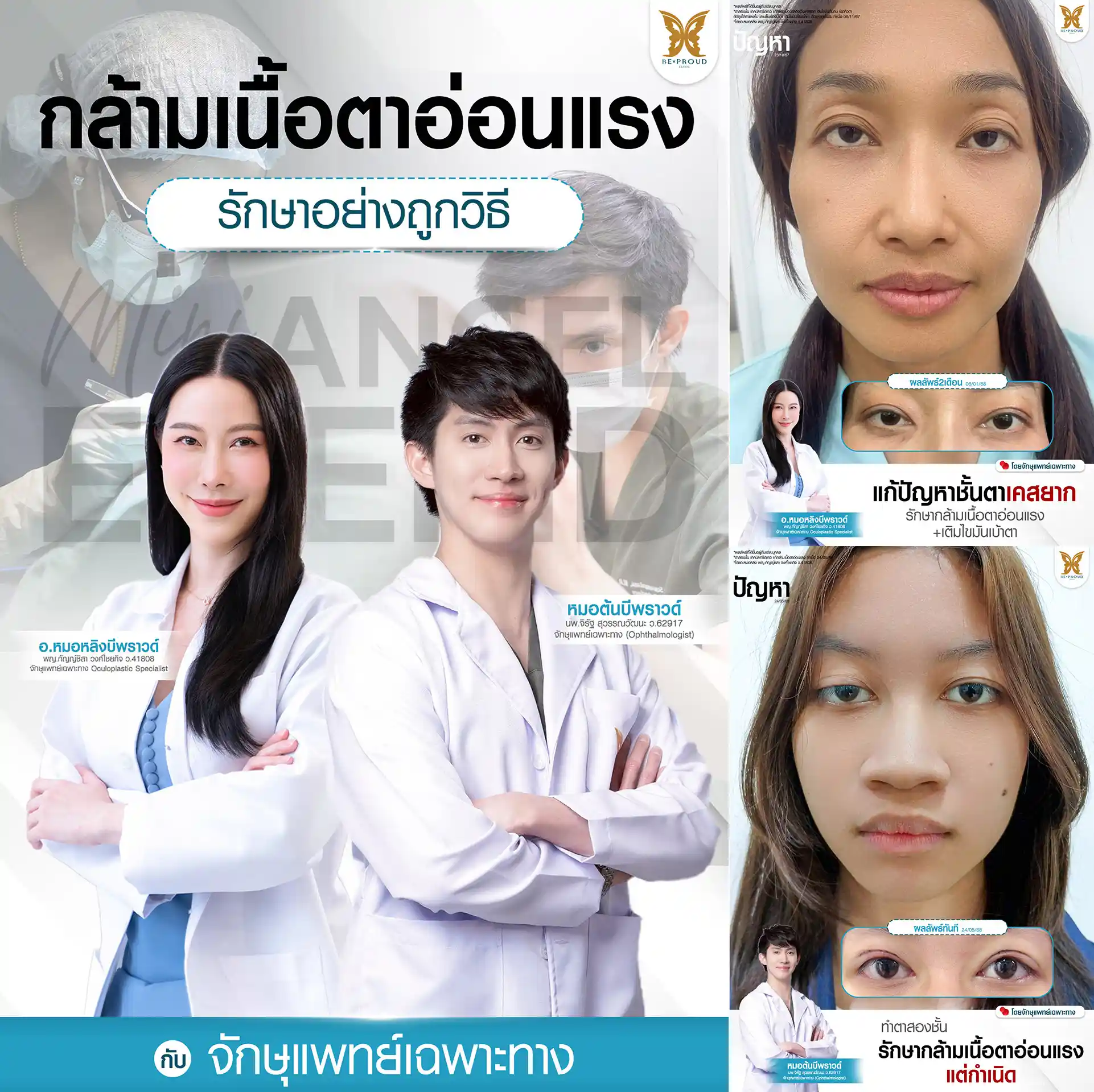 แก้กล้ามเนื้อตาอ่อนแรง ตาสองชั้นแก้กล้ามเนื้อตาอ่อนแรง เปลี่ยนการมองเห็นในทุกเช้าให้ไม่เหมือนเดิม