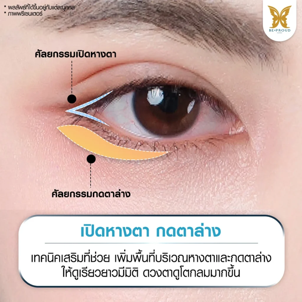เคล็ดลับตาเรียวยาวมีมิติเทคนิคเสริมเปิดหางตาและกดตาล่างที่ Beproud Clinic