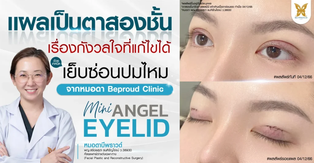 แผลเป็นตาสองชั้น เรื่องกังวลใจที่แก้ไขได้ด้วยเทคนิคเย็บซ่อนปมไหม โดยหมอดา Beproud Clinic
