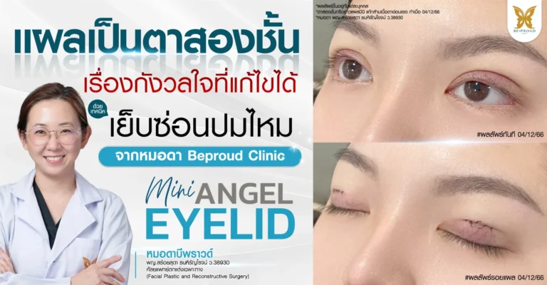 แผลเป็นตาสองชั้น เรื่องกังวลใจที่แก้ไขได้ด้วยเทคนิคเย็บซ่อนปมไหม โดยหมอดา Beproud Clinic