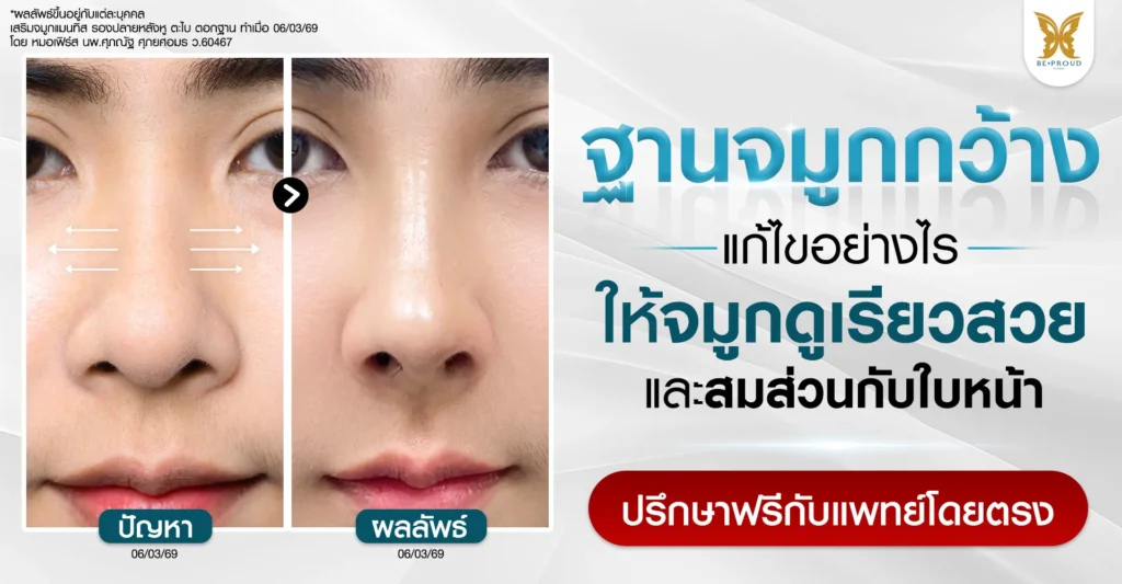 เปรียบเทียบก่อนและหลังศัลยกรรมแก้ไขฐานจมูกกว้าง ด้วยเทคนิคเสริมจมูก ตะไบ และตอกฐาน ที่ Beproud Clinic ช่วยให้ทรงจมูกเรียวสวยสมส่วน
