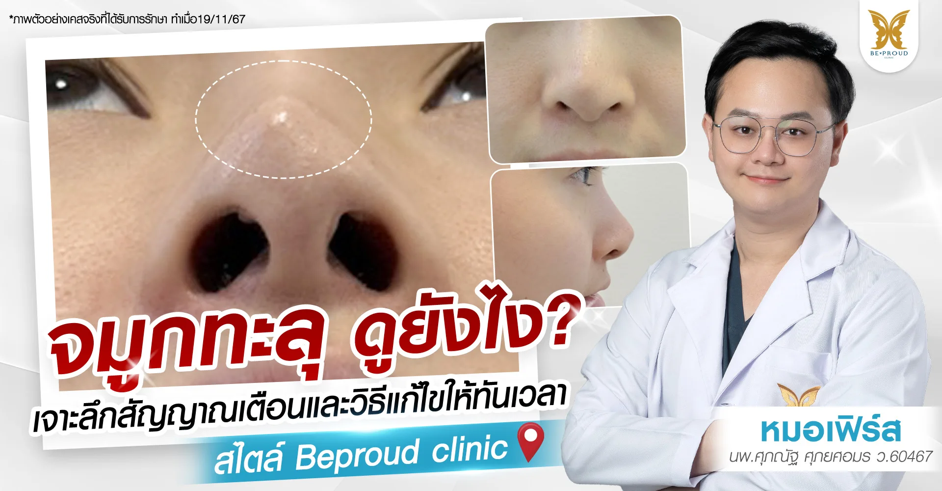 จมูกทะลุ ดูยังไง? เจาะลึก 5 สัญญาณเตือนและวิธีแก้ไขโดยหมอเฟิร์ส Beproud Clinic