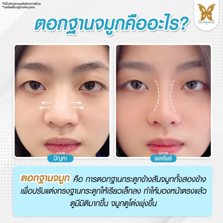 ตอกฐานจมูกคืออะไร พร้อมภาพเปรียบเทียบก่อนและหลังปรับฐานกระดูกจมูกให้เรียวเล็กมีมิติ ที่ Beproud Clinic