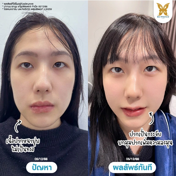 เปรียบเทียบก่อนและหลังทำศัลยกรรมปากกระจับทันทีของคุณฟา มาริโมะ ที่ Beproud Clinic ผลลัพธ์ทันที ปากกระจับ ยกมุมปากเพิ่มความละมุน ดูแลโดยหมออาร์ม นพ.กิตติ์ภวิศ พสุจรัสพงศ์
