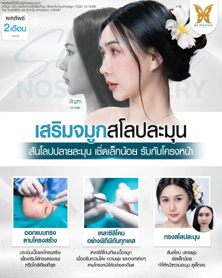 รีวิวผลลัพธ์แก้จมูก 2 เดือน ทรงสโลปละมุน สันสโลปปลายเชิดเล็กน้อย โดยทีมแพทย์ Beproud Clinic