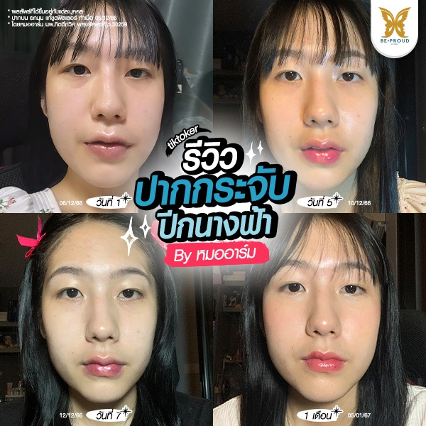 รีวิวไทม์ไลน์ทำศัลยกรรมปากกระจับปีกนางฟ้าสไตล์ญี่ปุ่น ของคุณฟา มาริโมะ ที่ Beproud Clinic ดูละมุนเป็นธรรมชาติ