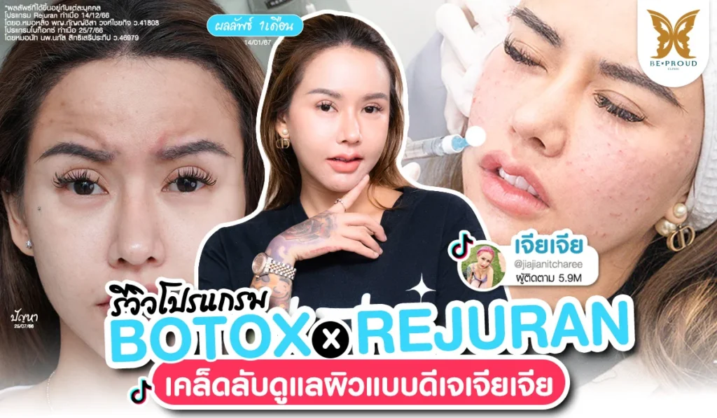 ดีเจเจียเจีย รีวิวโปรแกรม BOTOX คู่ REJURAN ผลลัพธ์ 1 เดือน ผิวตึงกระชับ ฉ่ำน้ำ ที่ Be proud Clinic ดูแลโดย พญ.กัญญาภัค วงศ์ไชยกิจ และ นพ.ภัสส์ สิทธิเสรีประทีป