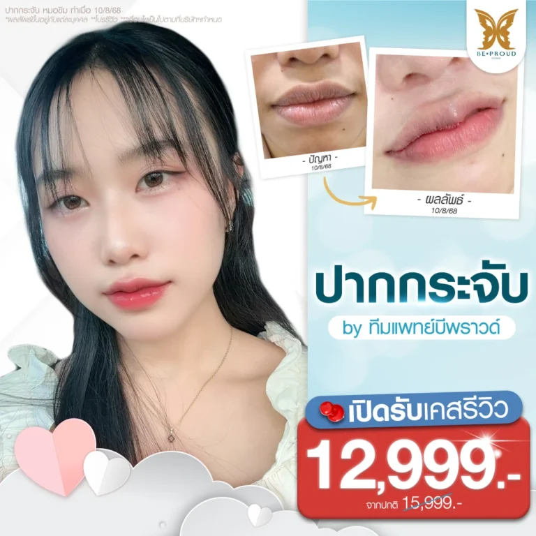 โปรโมชั่นศัลยกรรมปากกระจับราคาพิเศษสำหรับเคสรีวิว ที่บีพราวด์คลินิก แสดงภาพตัวอย่างเคสลูกค้าทำปาก รีวิวเปรียบเทียบก่อน-หลังทำศัลยกรรมปาก