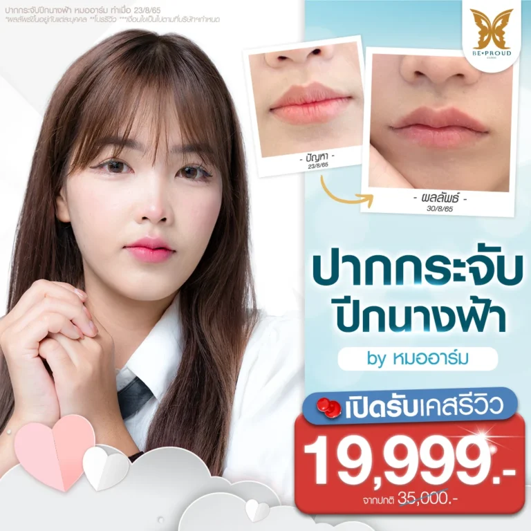 โปรโมชั่นศัลยกรรมปากกระจับปีกนางฟ้าราคาพิเศษสำหรับเคสรีวิว โดยหมออาร์ม ที่บีพราวด์คลินิก แสดงภาพตัวอย่างเคสลูกค้าทำปาก รีวิวเปรียบเทียบก่อน-หลังทำศัลยกรรมปาก