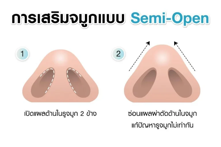 หัตถการเสริมจมูกแบบ Semi-Open Rhinoplasty บีพราวด์