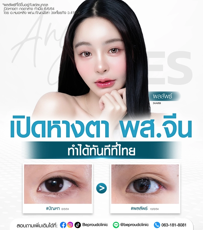 รีวิวศัลยกรรมตาเทรนด์พส.จีน เปิดหางตาเทคนิคพิเศษ ผลลัพธ์ก่อนหลังทำจริง ดูแลโดยทีมจักษุแพทย์ ที่ Beproud Clinic
