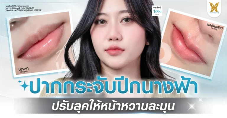 รีวิวปากกระจับปีกนางฟ้า ปรับลุคให้หน้าหวานละมุน เคสคุณป๊อก ดูแลโดยหมออาร์ม Beproud Clinic