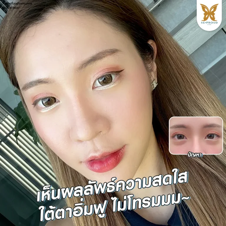 รีวิวผลลัพธ์โปรแกรมฟิลเลอร์ใต้ตา ผิวอิ่มฟูเรียบเนียนไม่โทรม คุณอิม jamsaiim Beproud Clinic