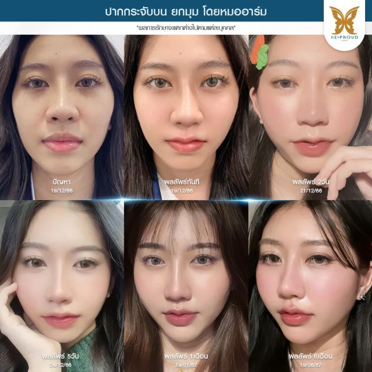 รีวิวไทม์ไลน์ปากกระจับบนยกมุม หมออาร์ม บีพราวด์ คลินิก ตั้งแต่ก่อนทำถึง 6 เดือน