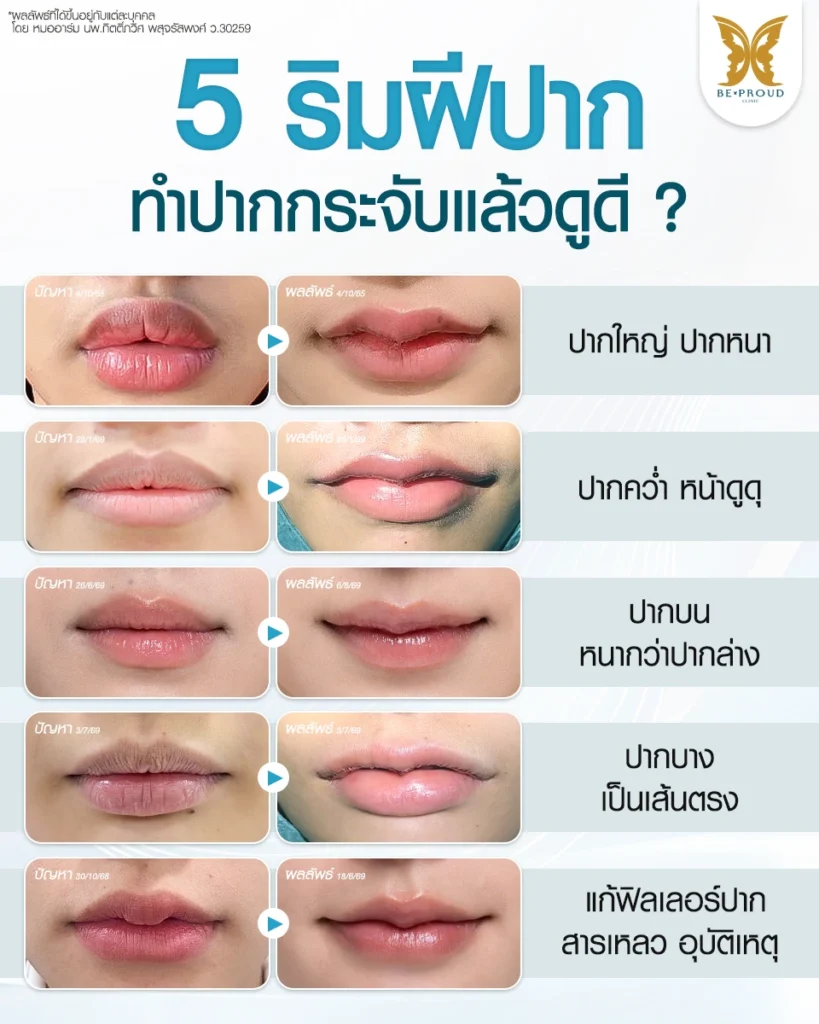 ปากกระจับ เหมาะกับใคร เช็กก่อนตัดสินใจ โดยแพทย์บีพราวด์ 5 ริมฝีปาก ทำปากกระจับแเล้วดูดี