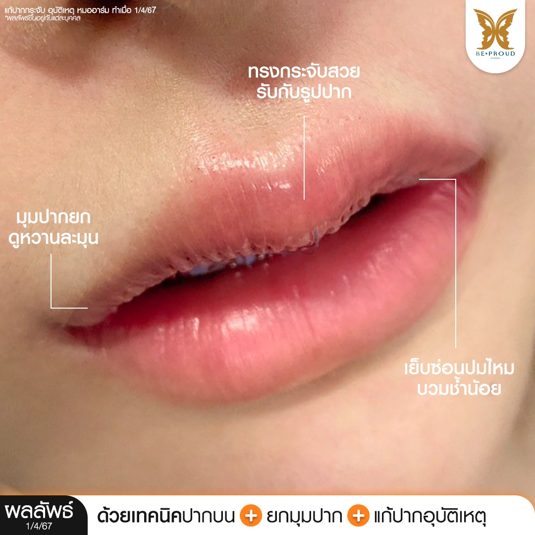 รีวิวผลลัพธ์ทันที แก้ปากผิดรูปจากอุบัติเหตุ เทคนิคยกมุมปาก หมออาร์ม Beproud Clinic