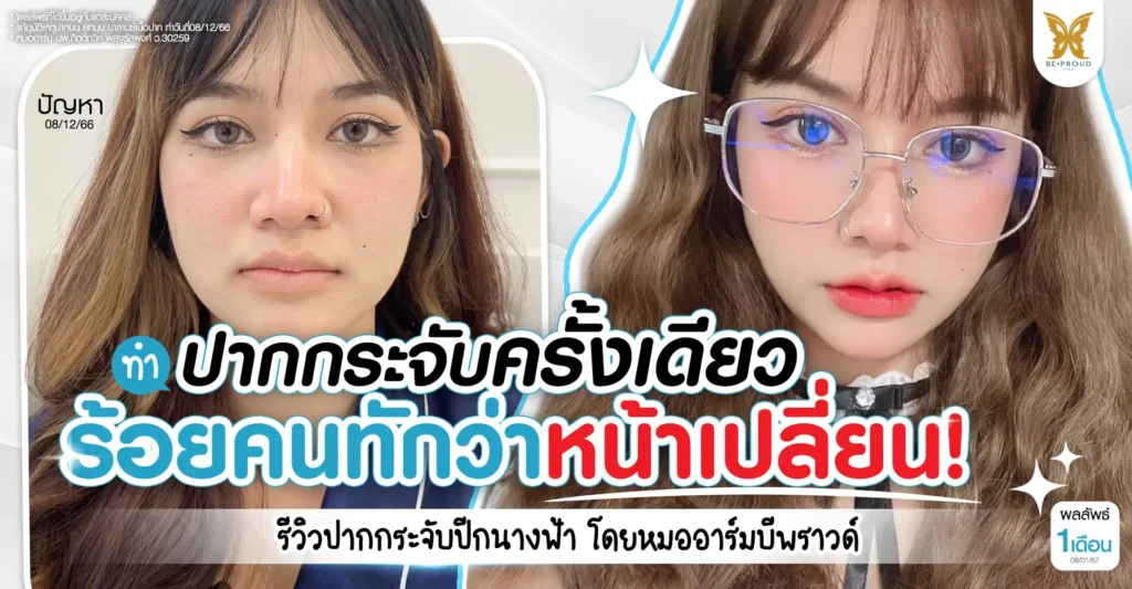 รีวิวแก้ปากอุบัติเหตุ ทำปากกระจับปีกนางฟ้า หมออาร์ม Beproud Clinic ผลลัพธ์ 1 เดือน คุณลูกเกด