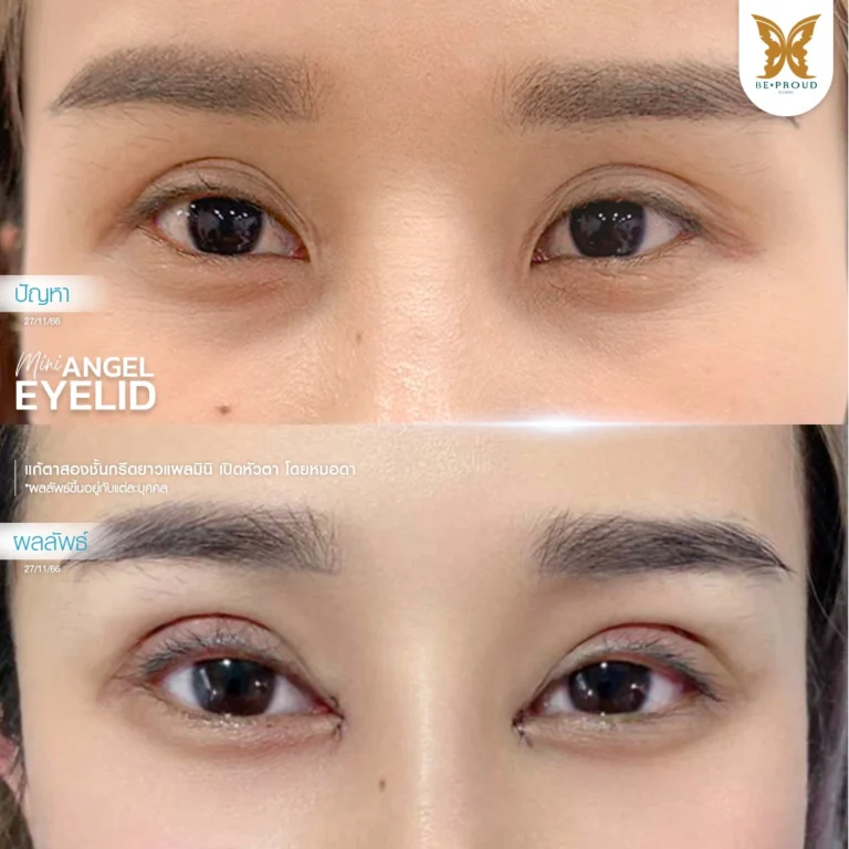 ภาพเปรียบเทียบก่อนหลังแก้ตาสองชั้นกรีดยาวแผลมินิ เปิดหัวตา หมอดา Beproud Clinic คุณหลินปิง