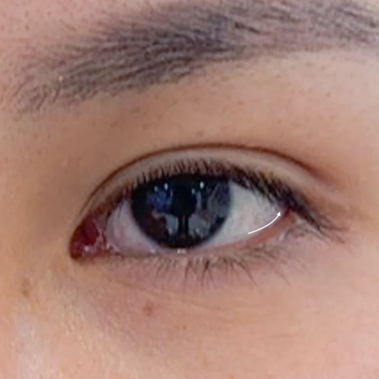 ตาล่างแบน