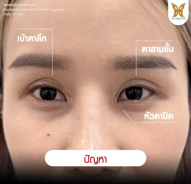 ภาพเปรียบเทียบก่อนหลังแก้ตาสองชั้นกรีดยาวแผลมินิ เปิดหัวตา หมอดา Beproud Clinic คุณหลินปิง