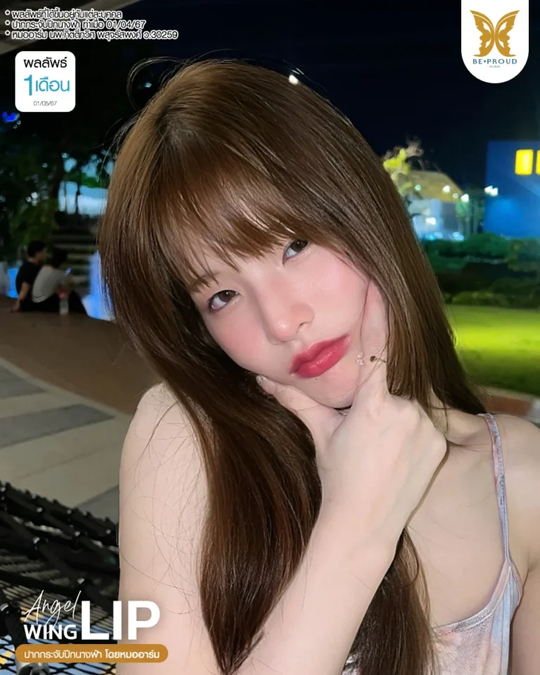 รีวิวผลลัพธ์ 1 เดือน แก้ปากกระจับปีกนางฟ้า เคสคุณซิน โดยหมออาร์ม Beproud Clinic