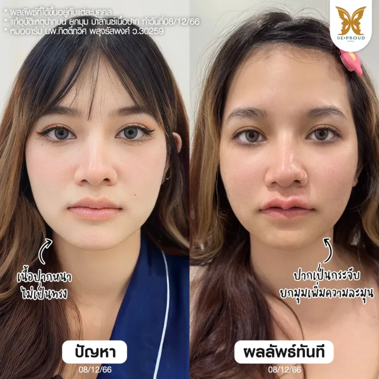 คุณลูกเกด ภาพก่อนหลังทำทันทีแก้อุบัติเหตุปากบน บาลานซ์เนื้อปาก ยกมุมปาก หมออาร์ม Beproud Clinic