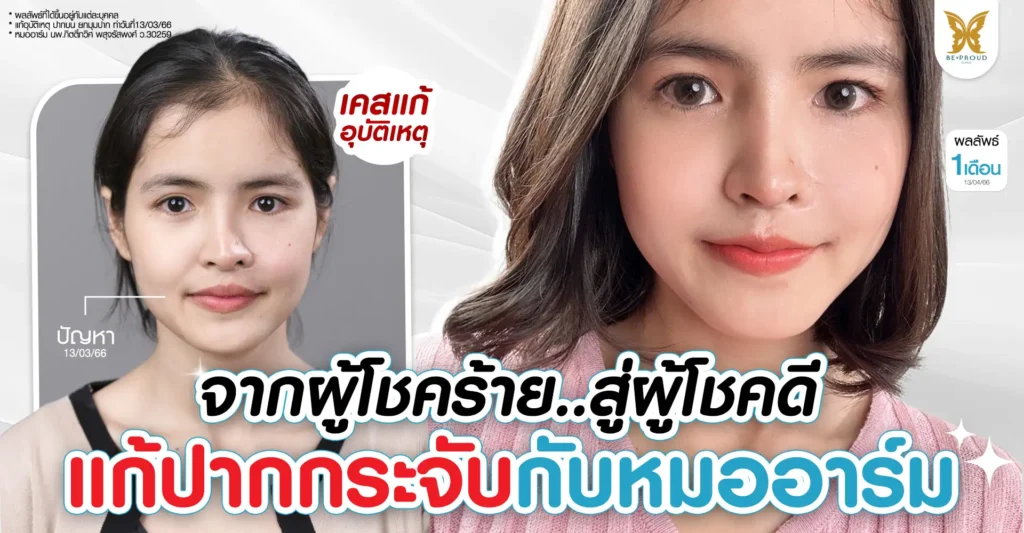 ภาพเปรียบเทียบก่อนและหลังแก้ปากกระจับเคสอุบัติเหตุของคุณแป้ง โดยหมออาร์ม Beproud Clinic