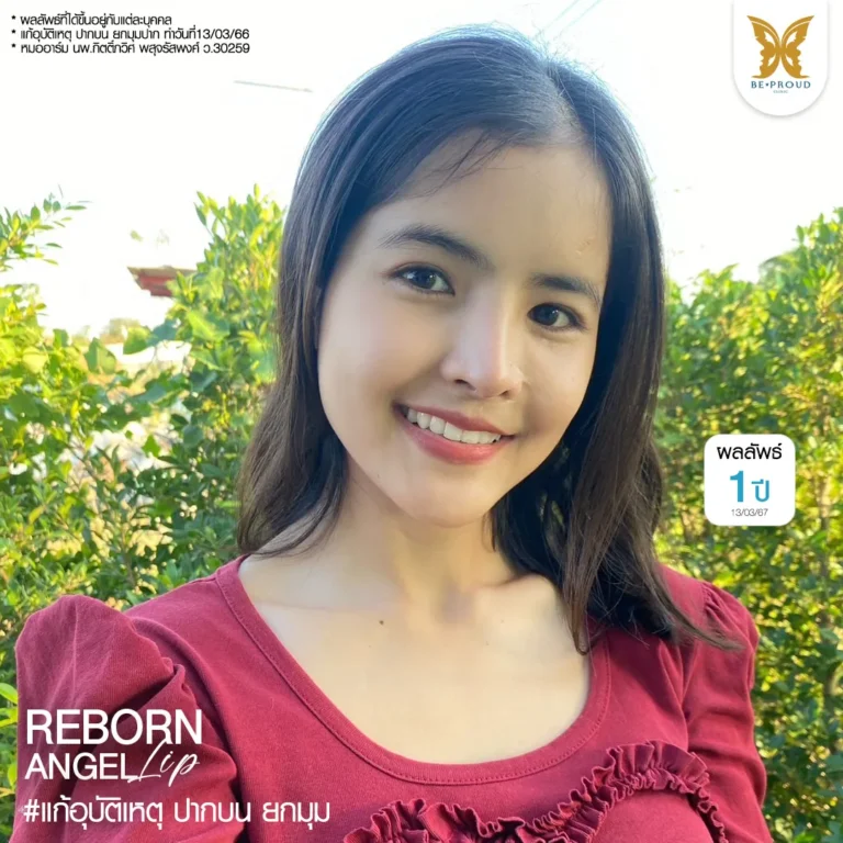 ภาพผลลัพธ์ 1 ปี หลังแก้ปากกระจับเคสอุบัติเหตุของคุณแป้ง โดยหมออาร์ม Beproud Clinic ทรงปากกระจับปีกนางฟ้า Reborn Angel Lip ยิ้มสวยมั่นใจ