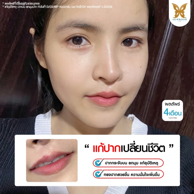 ภาพผลลัพธ์ 4 เดือน หลังแก้ปากกระจับเคสอุบัติเหตุของคุณแป้ง โดยหมออาร์ม Beproud Clinic แก้ปากกระจับบนพร้อมยกมุมปาก ทรงสวยมั่นใจ