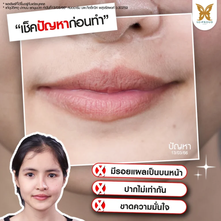 ภาพเช็กปัญหาริมฝีปากก่อนแก้ปากกระจับเคสอุบัติเหตุของคุณแป้ง ปัญหาปากไม่เท่ากันและมีรอยแผลเป็น โดยหมออาร์ม Beproud Clinic