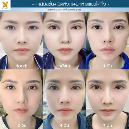 ตาสองชั้น ศัลยกรรมตาสองชั้น เทคนิคทำตาสองชั้น รีวิวทำตาสองชั้น