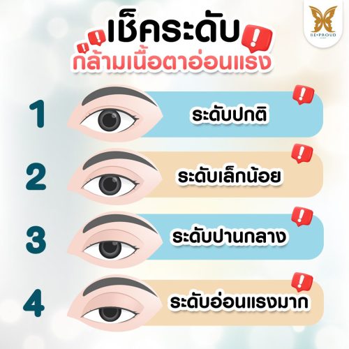 กล้ามเนื้อตาอ่อนแรง กล้ามเนื้อตาอ่อนแรง