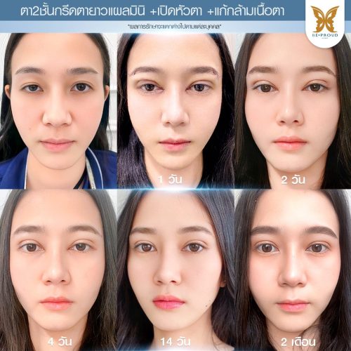 กล้ามเนื้อตาอ่อนแรง กล้ามเนื้อตาอ่อนแรง