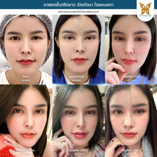 เปิดหัวตา, เปิดหัวตาคือ, เปิดหัวตาดีไหม, เปิดหัวตาเหมาะกับใคร, ข้อดีข้อเสียเปิดหัวตา, รีวิวเปิดหัวตา เปิดหัวตา, เปิดหัวตาคือ, เปิดหัวตาดีไหม, เปิดหัวตาเหมาะกับใคร, ข้อดีข้อเสียเปิดหัวตา, รีวิวเปิดหัวตา