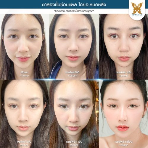 เปิดหัวตา, เปิดหัวตาคือ, เปิดหัวตาดีไหม, เปิดหัวตาเหมาะกับใคร, ข้อดีข้อเสียเปิดหัวตา, รีวิวเปิดหัวตา เปิดหัวตา, เปิดหัวตาคือ, เปิดหัวตาดีไหม, เปิดหัวตาเหมาะกับใคร, ข้อดีข้อเสียเปิดหัวตา, รีวิวเปิดหัวตา