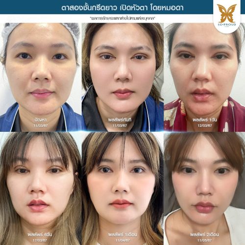 เปิดหัวตา, เปิดหัวตาคือ, เปิดหัวตาดีไหม, เปิดหัวตาเหมาะกับใคร, ข้อดีข้อเสียเปิดหัวตา, รีวิวเปิดหัวตา เปิดหัวตา, เปิดหัวตาคือ, เปิดหัวตาดีไหม, เปิดหัวตาเหมาะกับใคร, ข้อดีข้อเสียเปิดหัวตา, รีวิวเปิดหัวตา