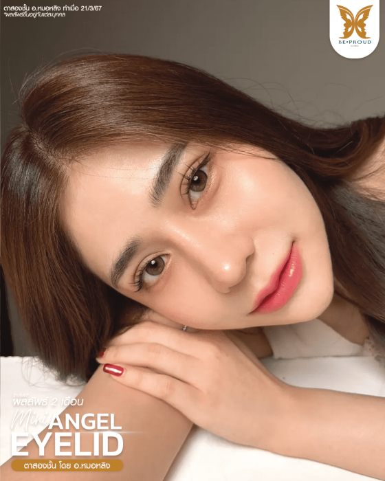 ตาสองชั้นแผลมินิ หมอหลิง