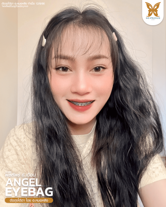 ตัดถุงใต้ตาซ่อนแผล หมอหลิง