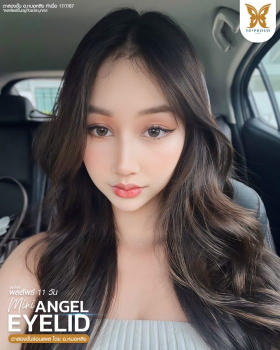 ตาสองชั้นซ่อนแผล หมอหลิง