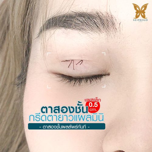 ตาสองชั้น ศัลยกรรมตาสองชั้น เทคนิคทำตาสองชั้น รีวิวทำตาสองชั้น