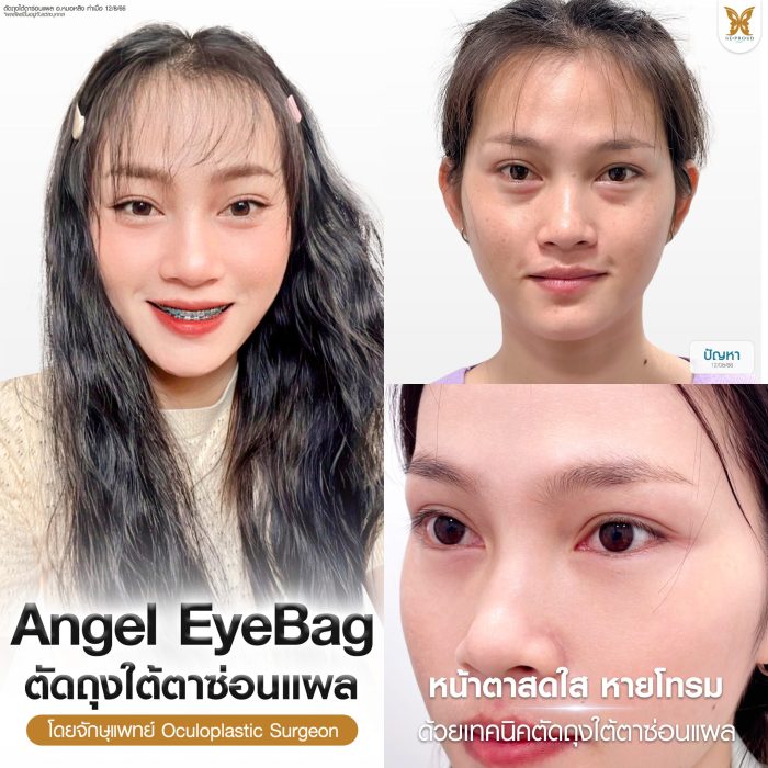 รีวิวถุงใต้ตา