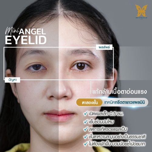 กล้ามเนื้อตาอ่อนแรง กล้ามเนื้อตาอ่อนแรง